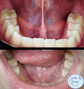 Laser Frenectomy - Tongue Tied Procedure | Smiles By Hanna