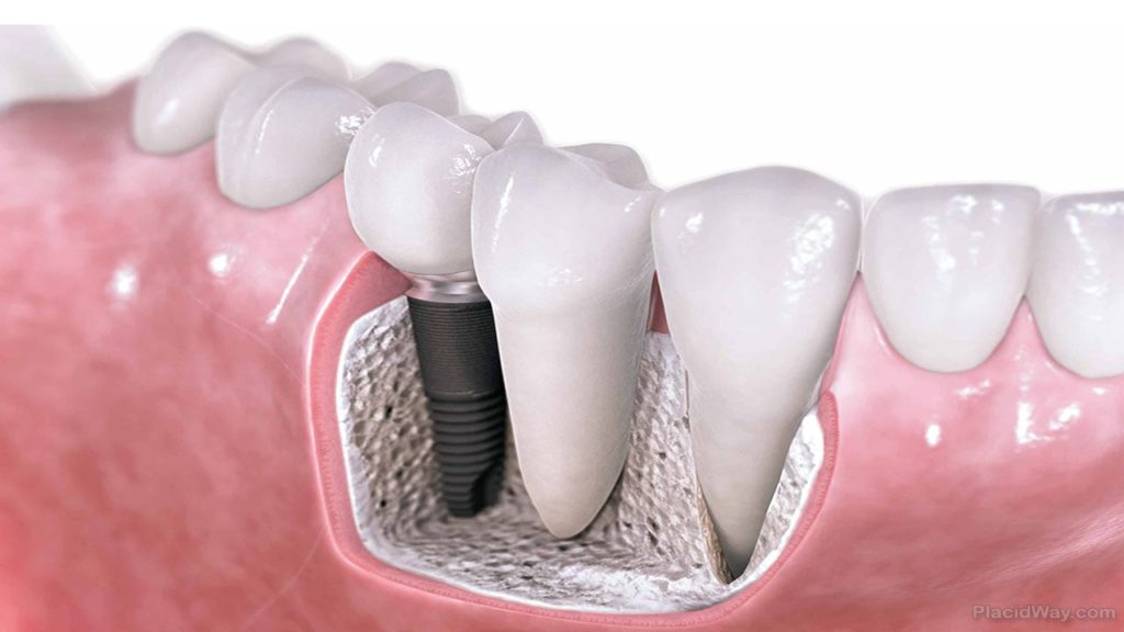 Image result for 5 â Dental implants