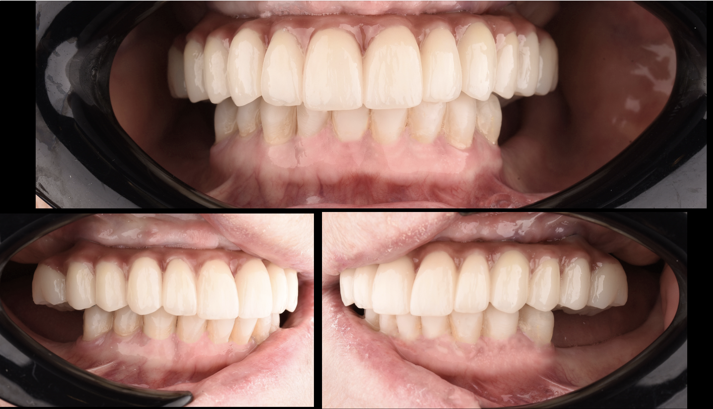 Dental Implant Procedures Before After Smiles By Hanna