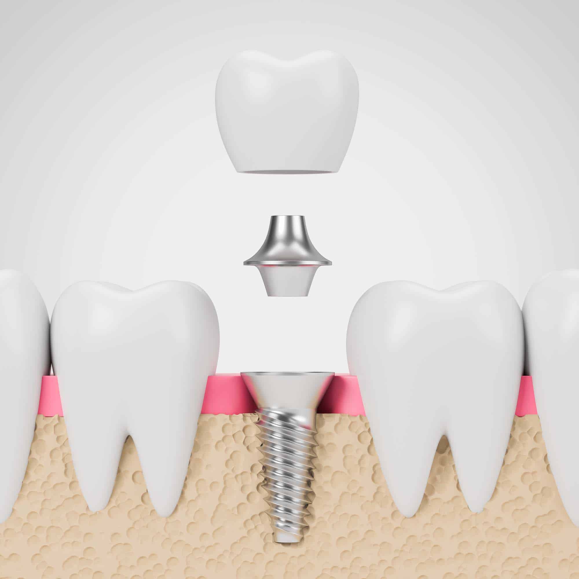 Zirconia Dental Implants