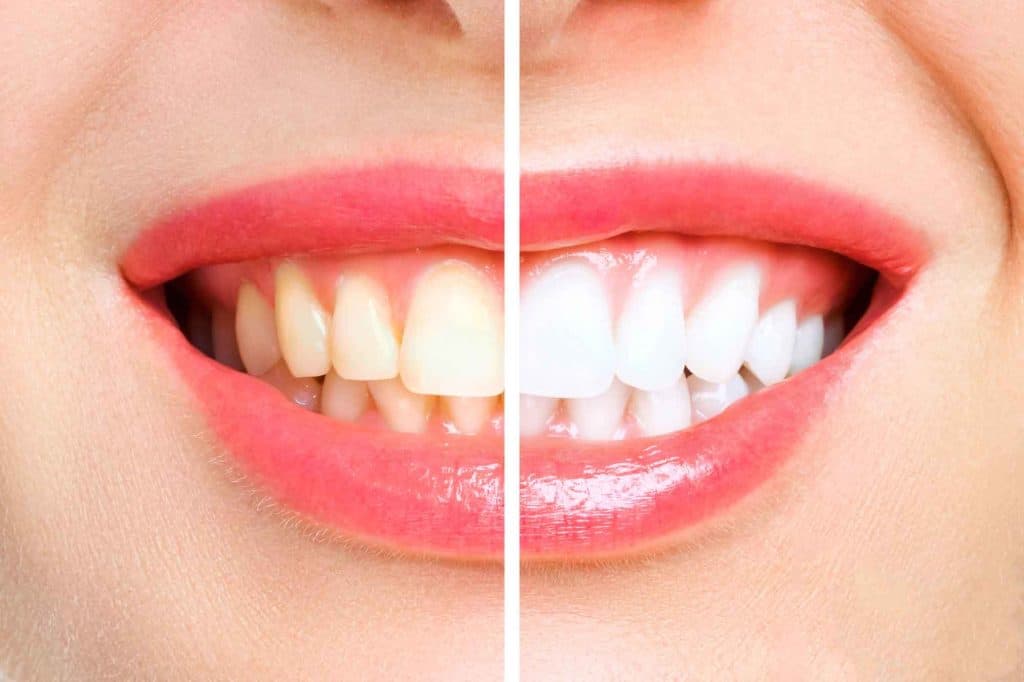 Teeth Whitening Options: Professional In-Office Whitening vs At-Home Kits