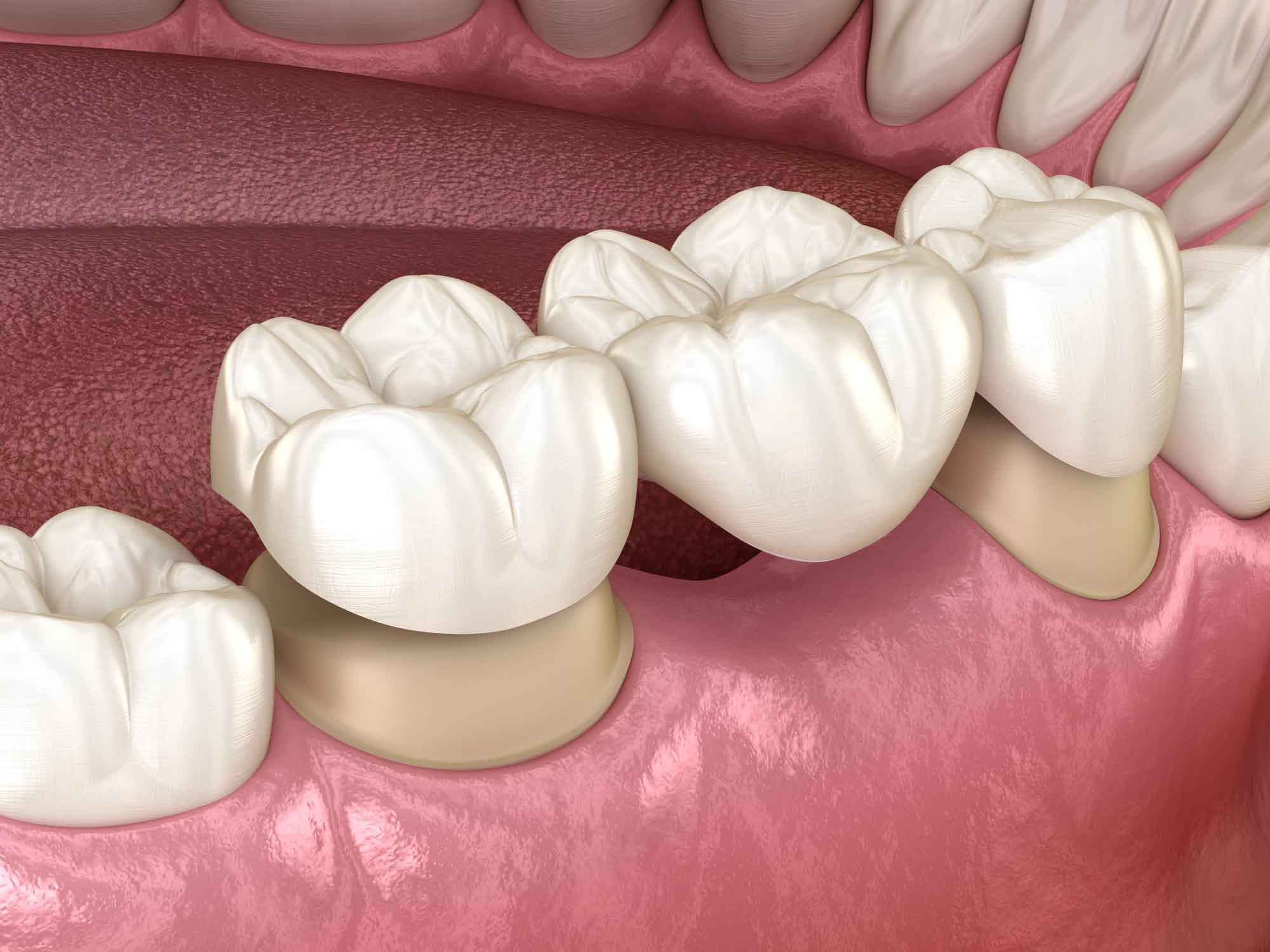 Dental Bridges Are an Alternative to Implants