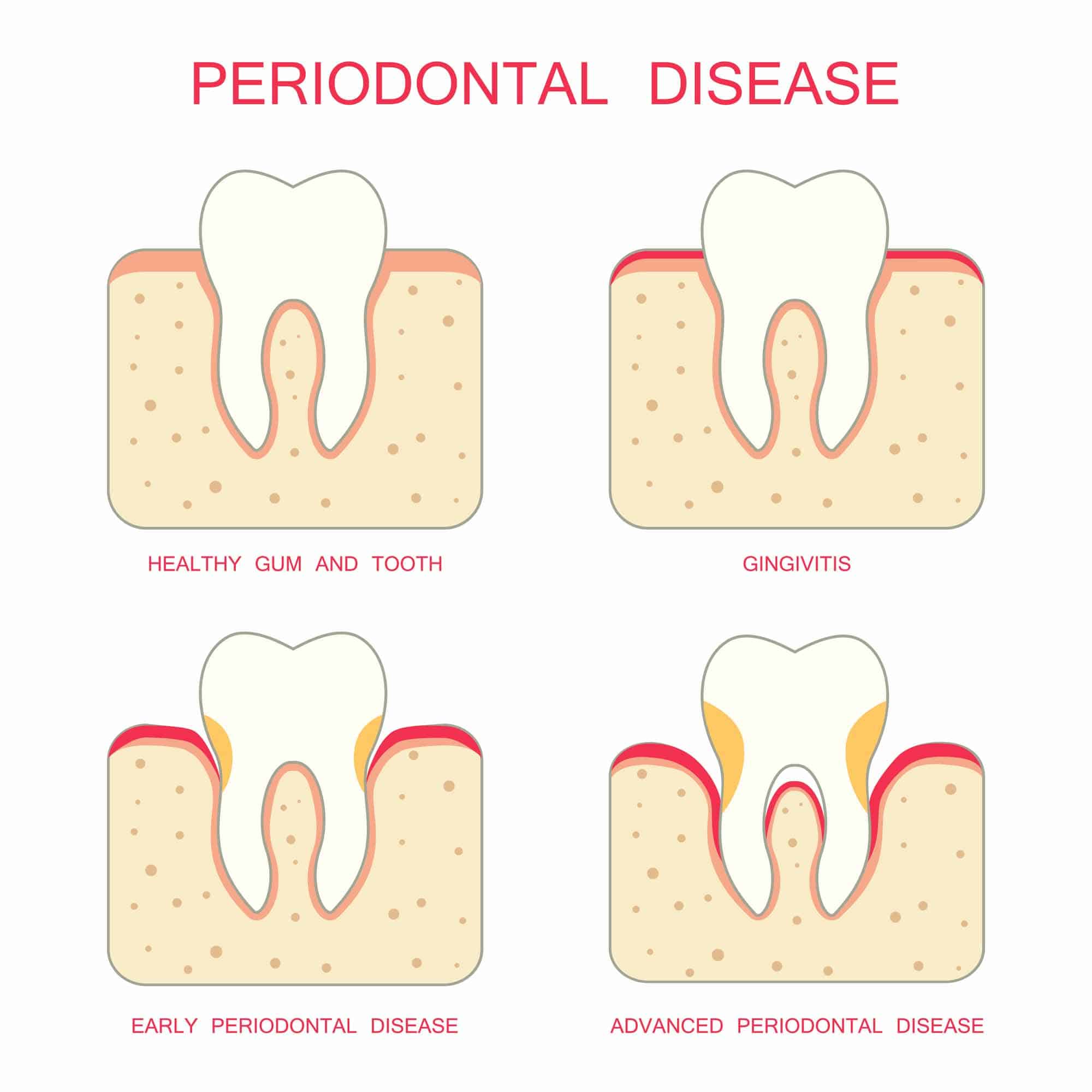 Severe Gum Disease