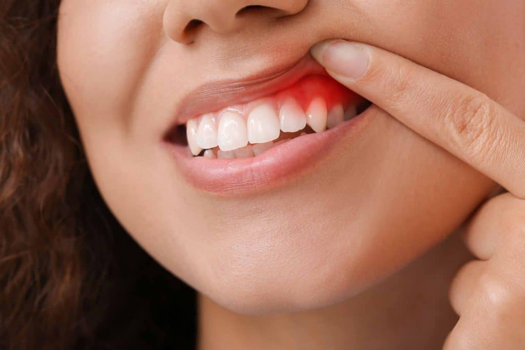 Recognizing and Treating Gum Disease