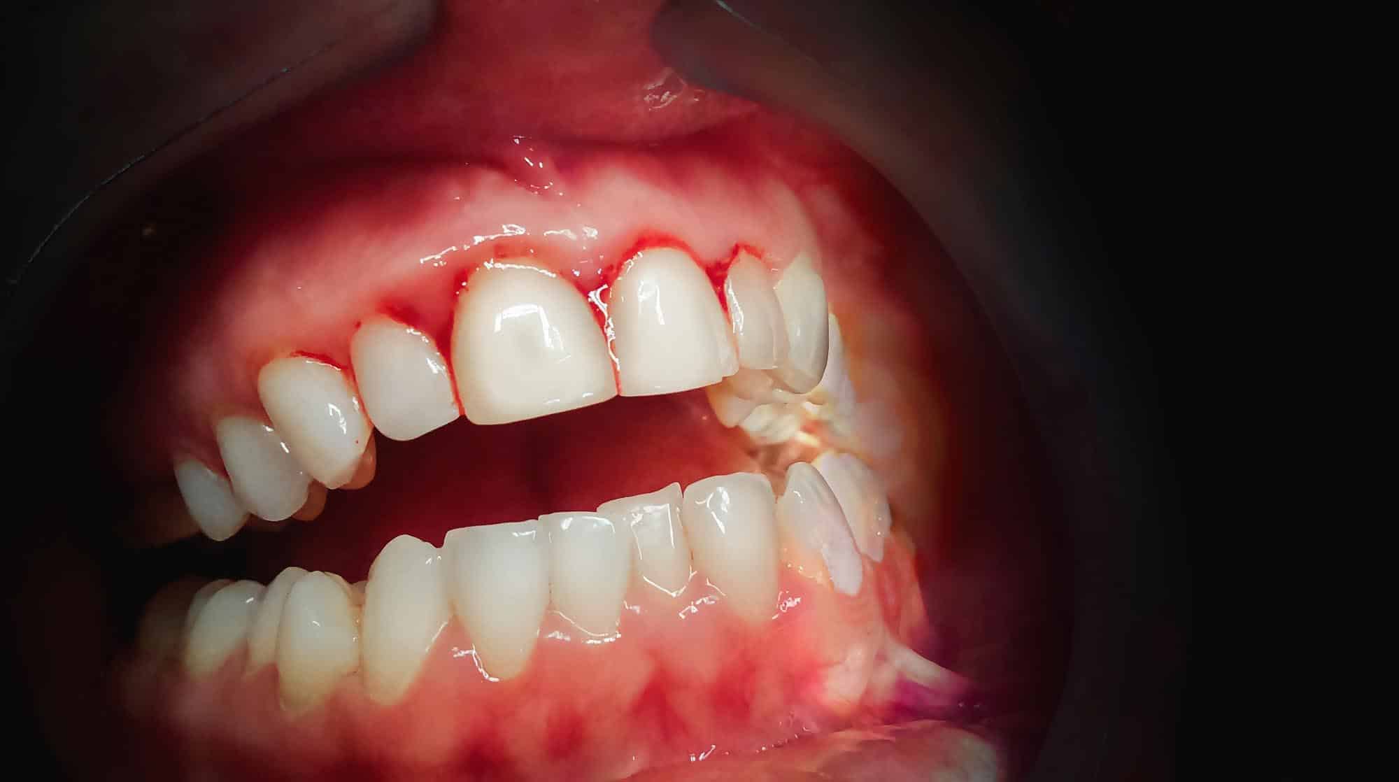 Unhealthy Gums - Bleeding Gums