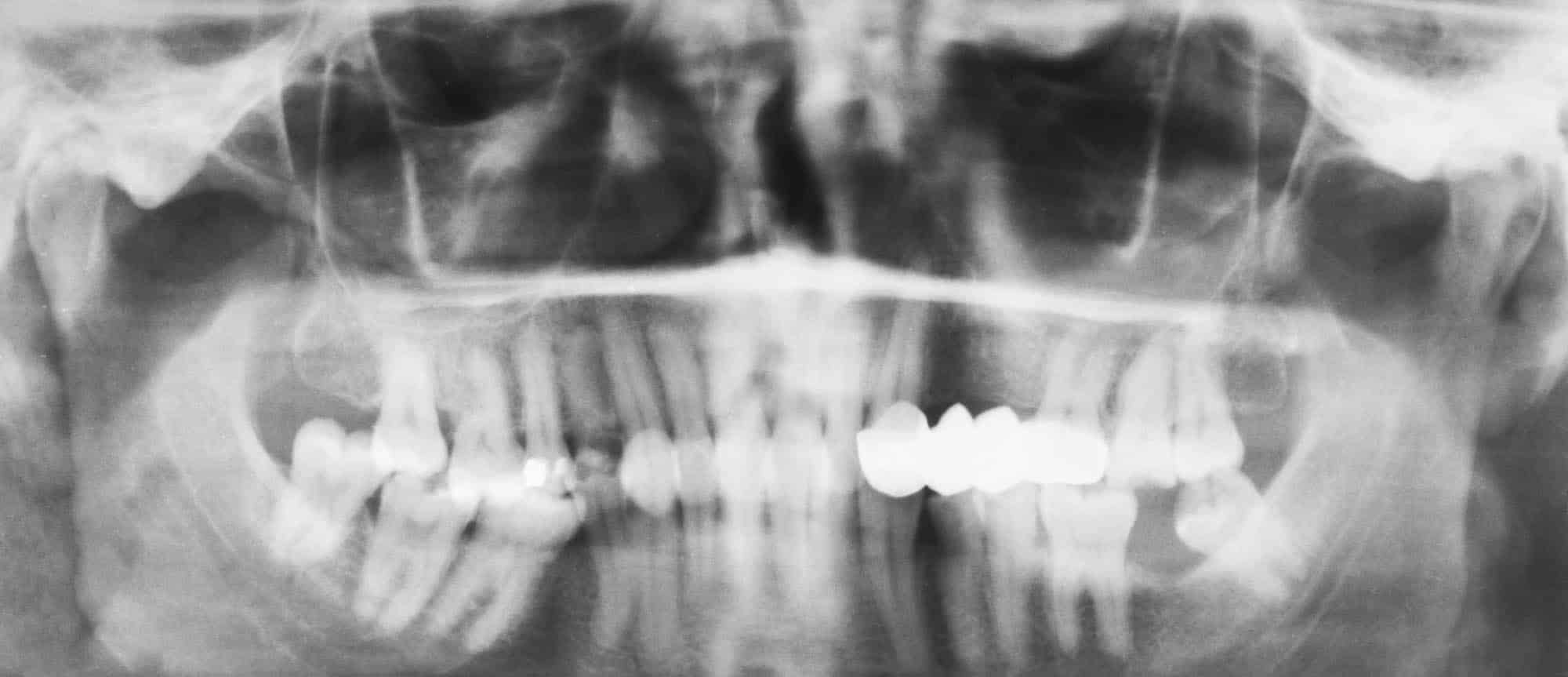 Dental X-rays with Crowns